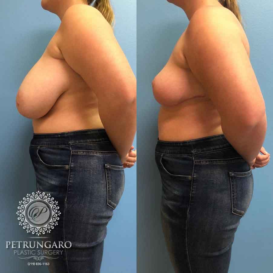 20-breast-reduction-2