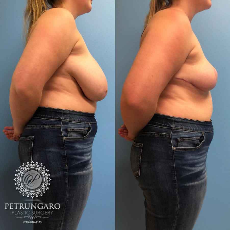 20-breast-reduction-3