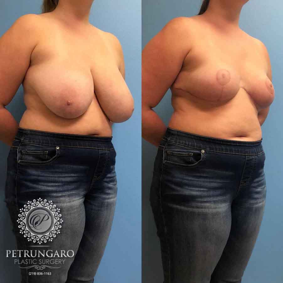20-breast-reduction-5