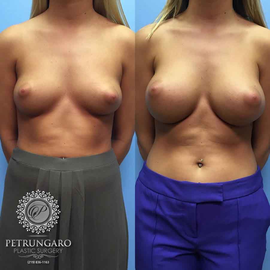 21-before-after-breast-augmentation-implants-5-1