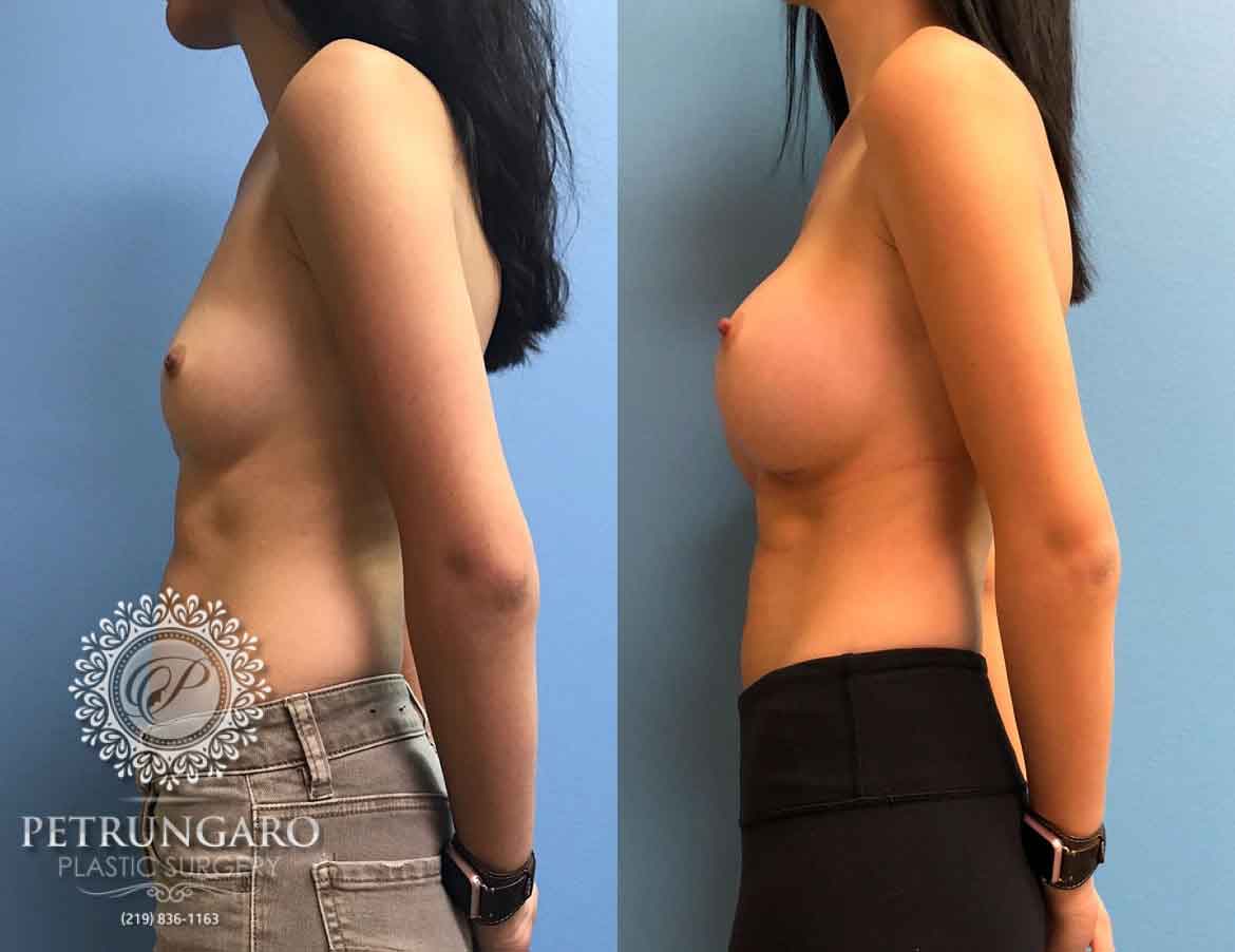 24-female-breast-augmentation-5