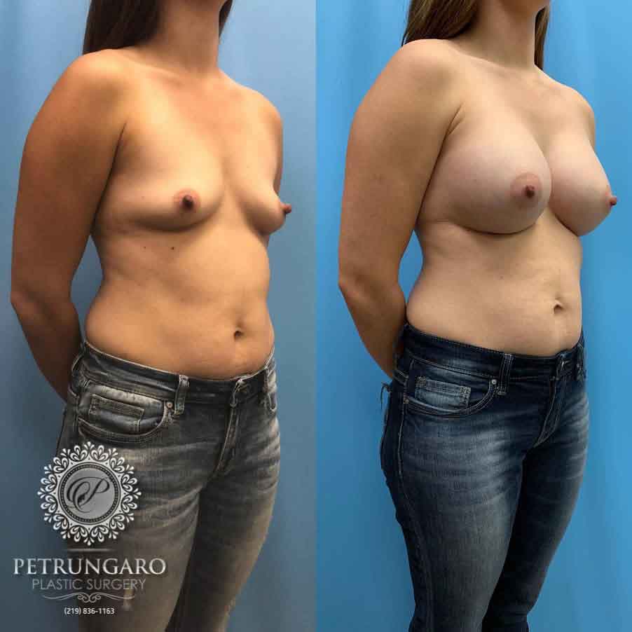 28-before-after-breast-augmentation-implants-2