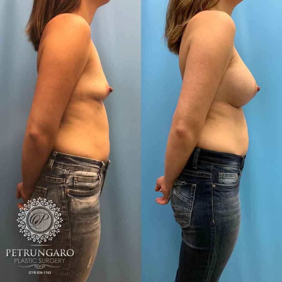 28-before-after-breast-augmentation-implants-3