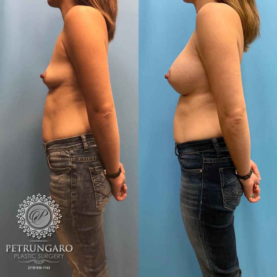 28-before-after-breast-augmentation-implants-4