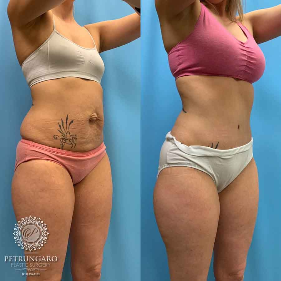 29-before-after-tummy-tuck-lipo-360-2