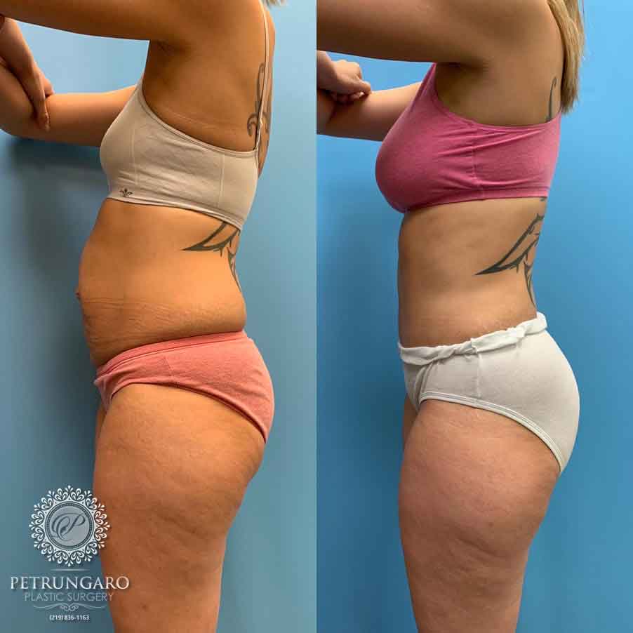 29-before-after-tummy-tuck-lipo-360-4