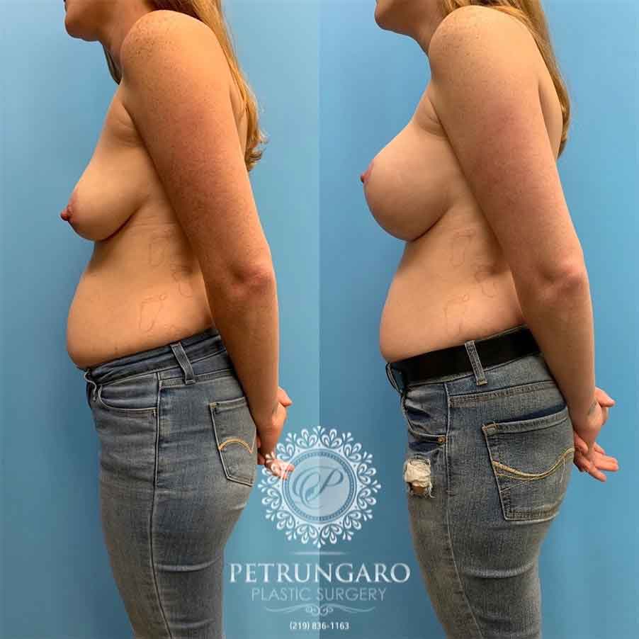 31-before-after-breast-lift-with-implants-2