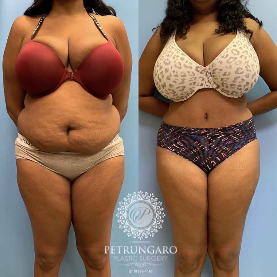 33-woman-before-after-photo-tummy-tuck-lipo-360-1