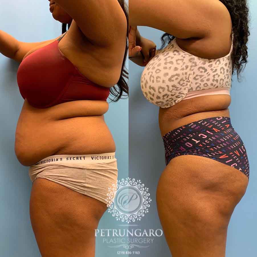 33-woman-before-after-photo-tummy-tuck-lipo-360-2