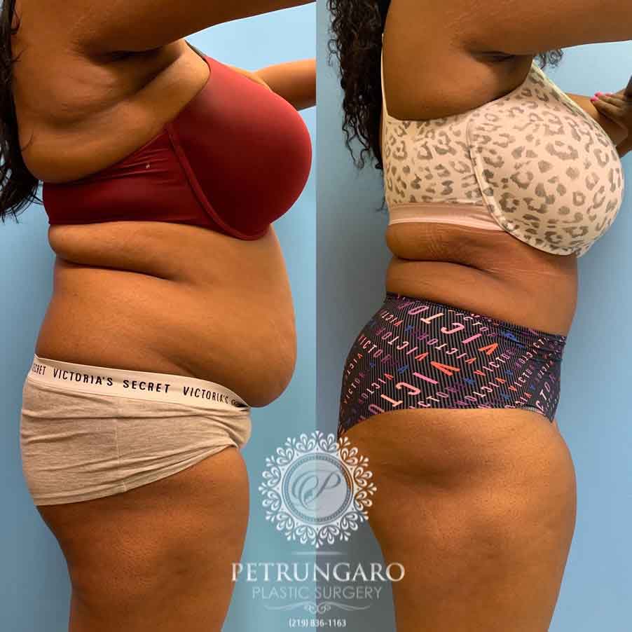 33-woman-before-after-photo-tummy-tuck-lipo-360-3