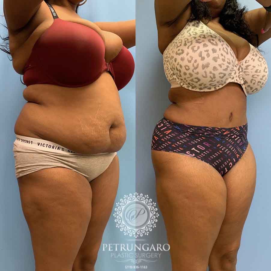 33-woman-before-after-photo-tummy-tuck-lipo-360-4