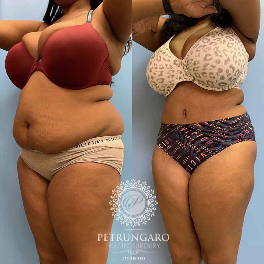 33-woman-before-after-photo-tummy-tuck-lipo-360-5