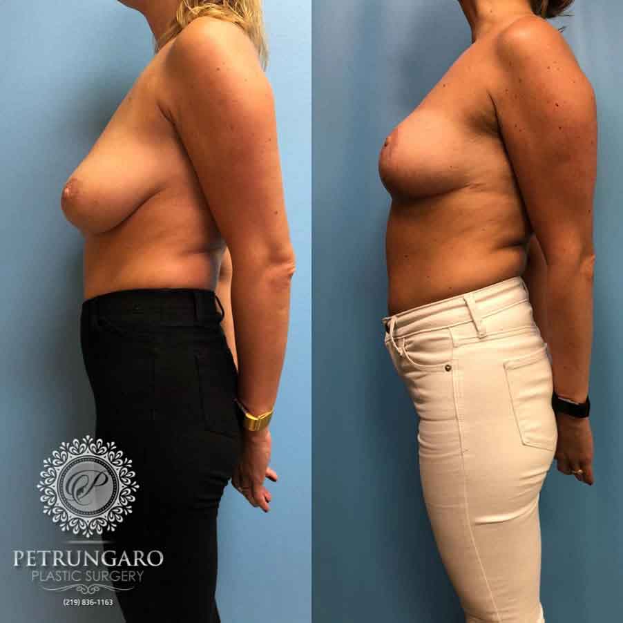 36-before-after-breast-lift-4
