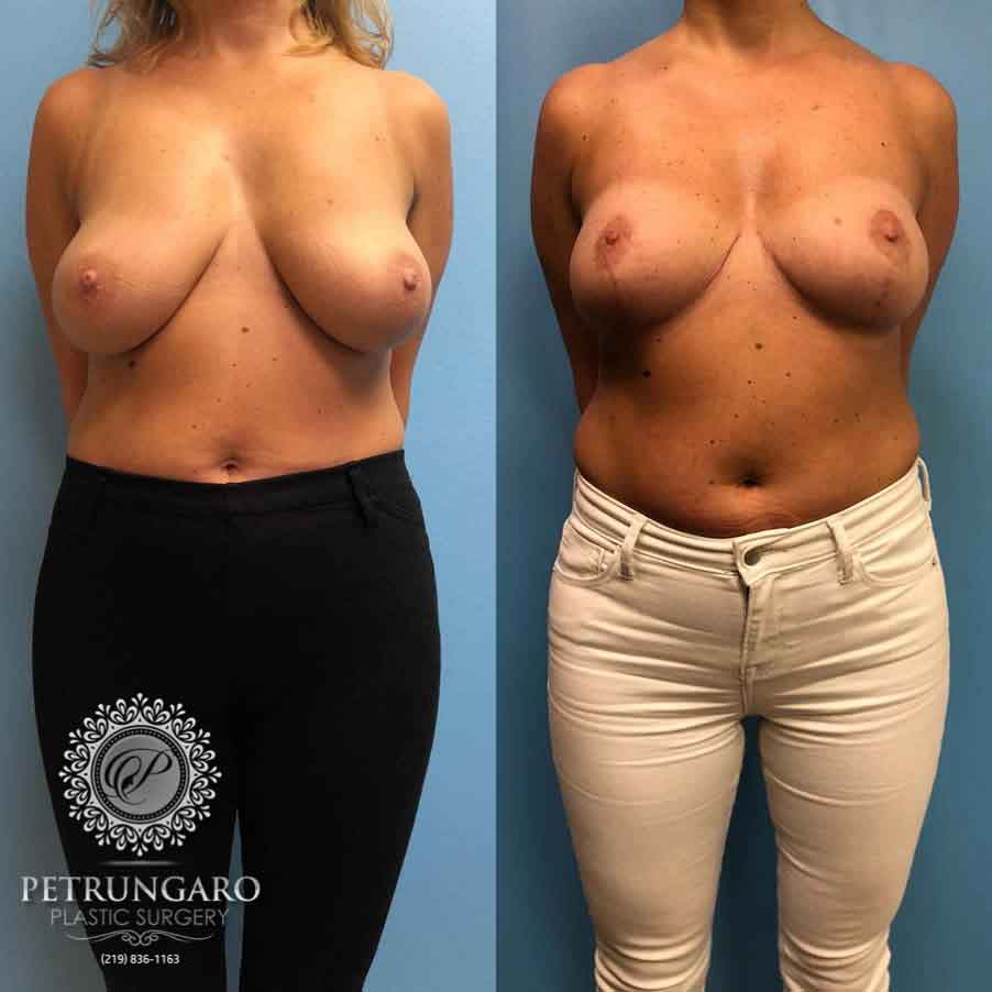 36-before-after-breast-lift-5