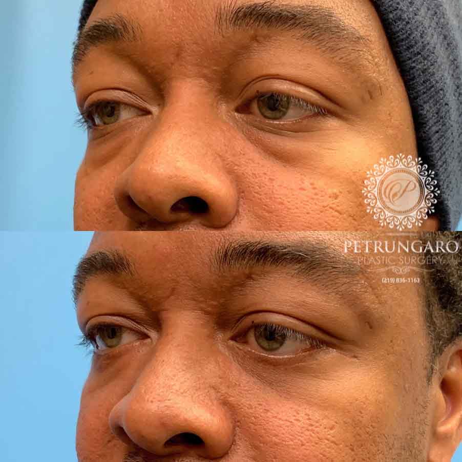 36-before-after-photo-lower-eyelid-lift-5