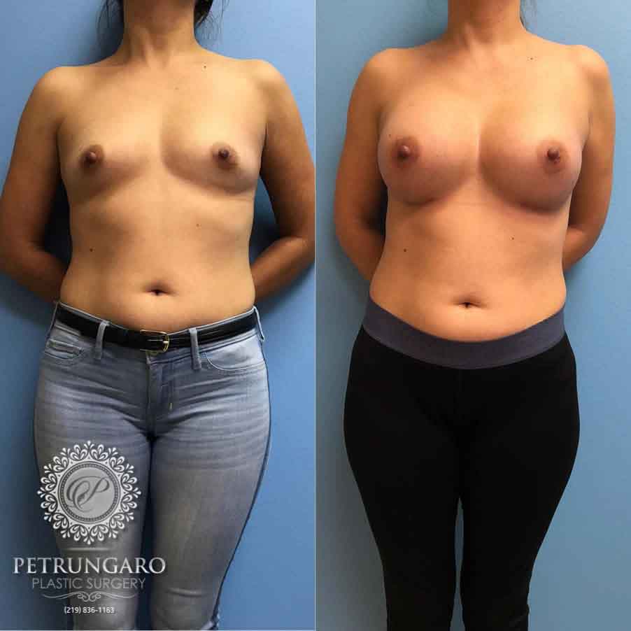 36-breast-augmentation-implants-1