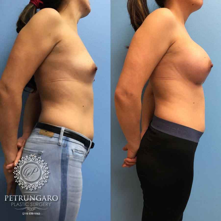 36-breast-augmentation-implants-2