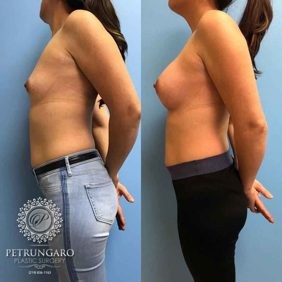 36-breast-augmentation-implants-3