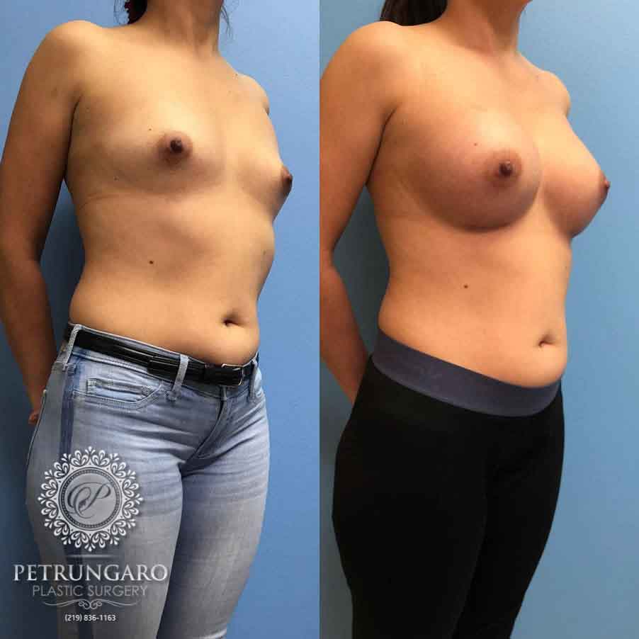 36-breast-augmentation-implants-4