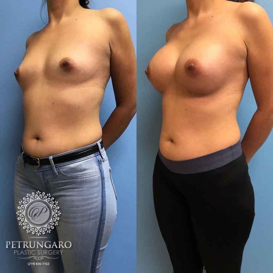 36-breast-augmentation-implants-5