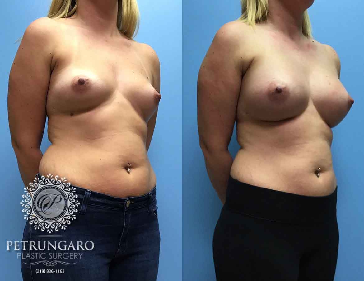 36-woman-3-months-after-breast-augmentation-2
