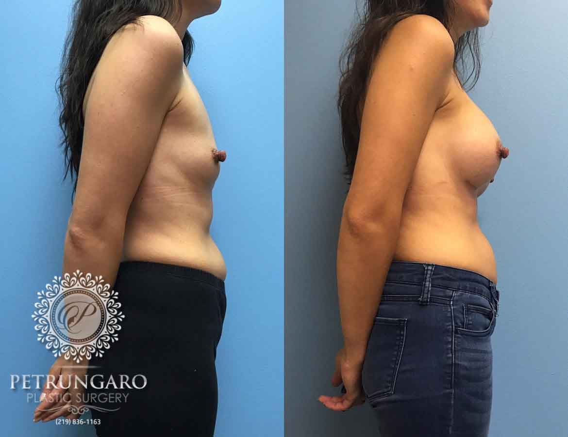 37-breast-augmentation-implants-chicago-4