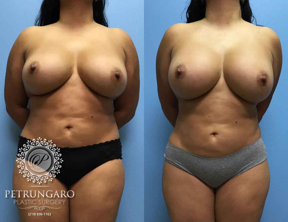 38-breast-augmentation-5-1