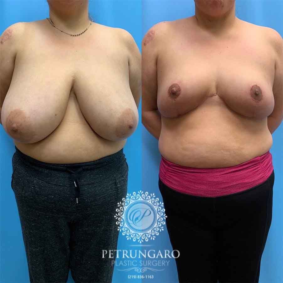 40-before-after-photo-breast-reduction-1