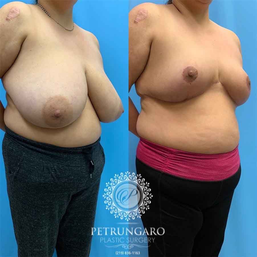 40-before-after-photo-breast-reduction-4