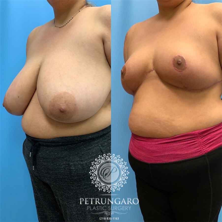 40-before-after-photo-breast-reduction-5