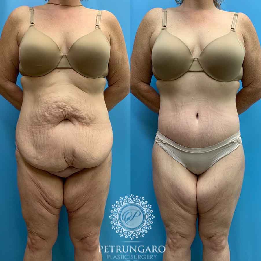 41-before-after-photo-bodylift-3