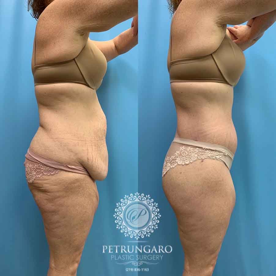 41-before-after-photo-bodylift-4