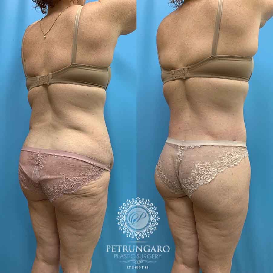 41-before-after-photo-bodylift-8