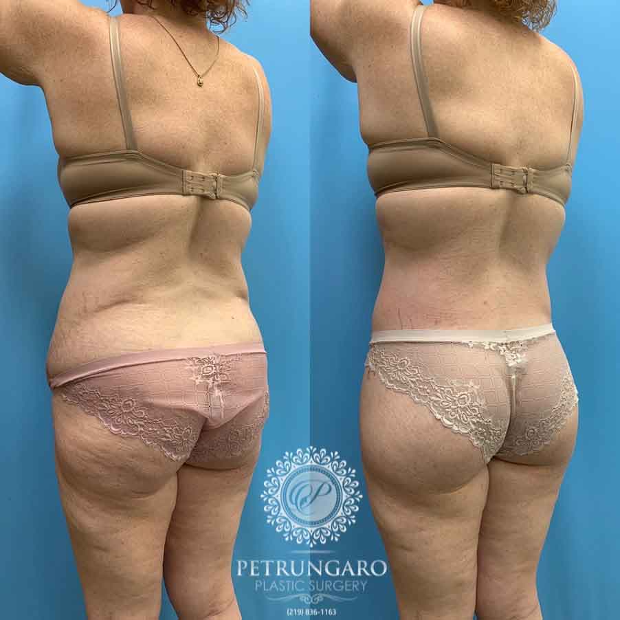 41-before-after-photo-bodylift-9
