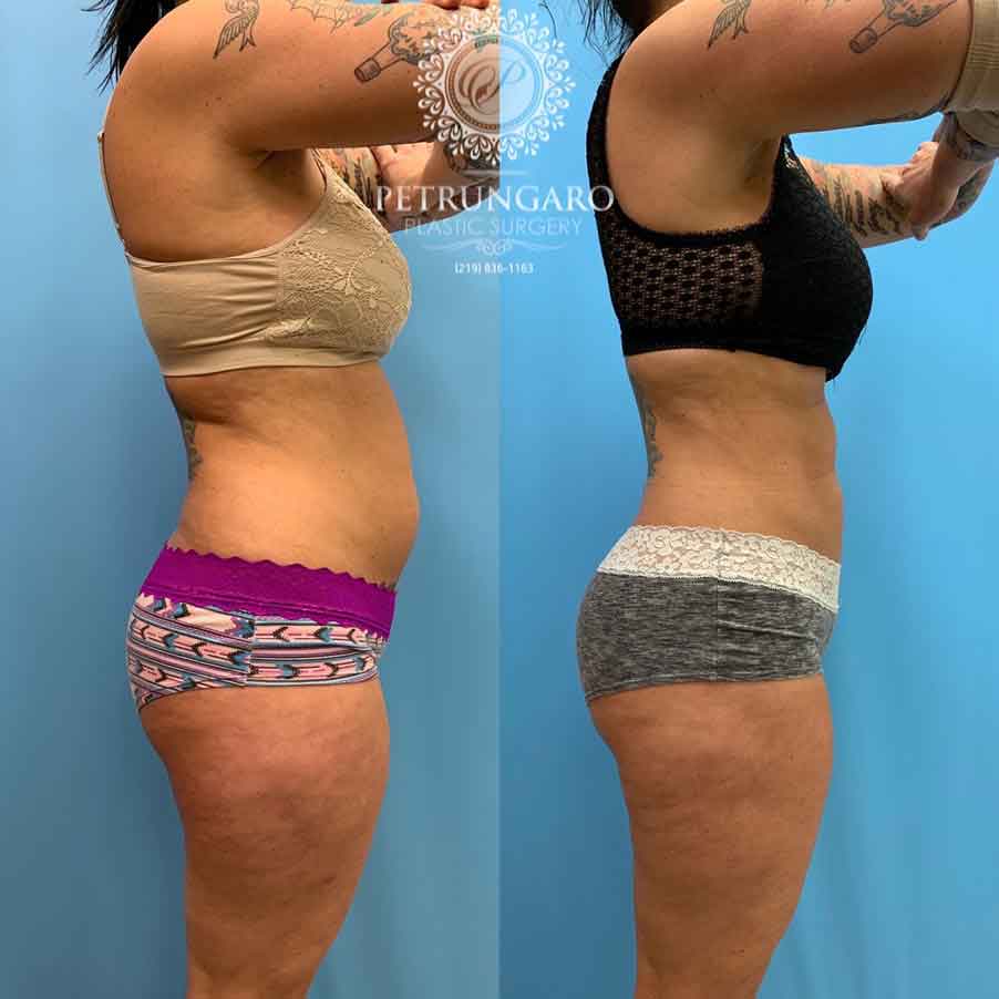 42-before-after-photo-lipo-360-2