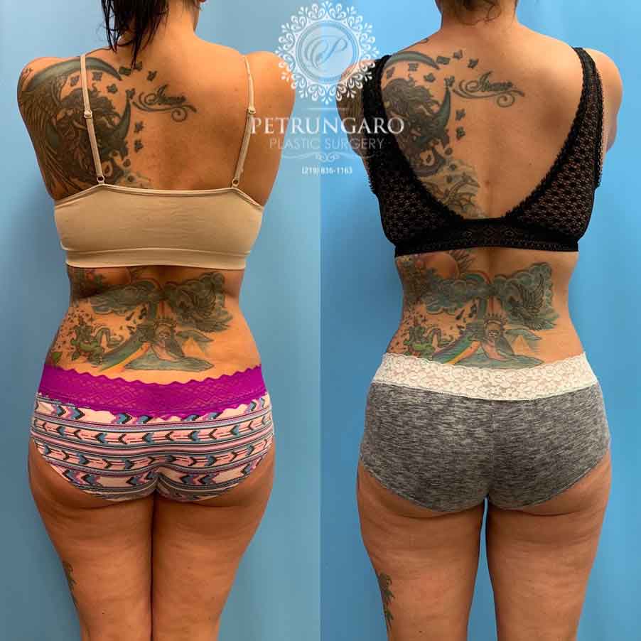42-before-after-photo-lipo-360-3