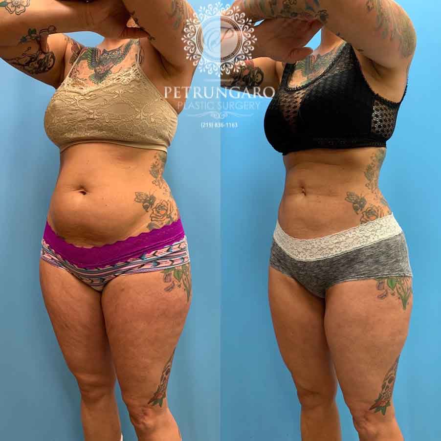 42-before-after-photo-lipo-360-5