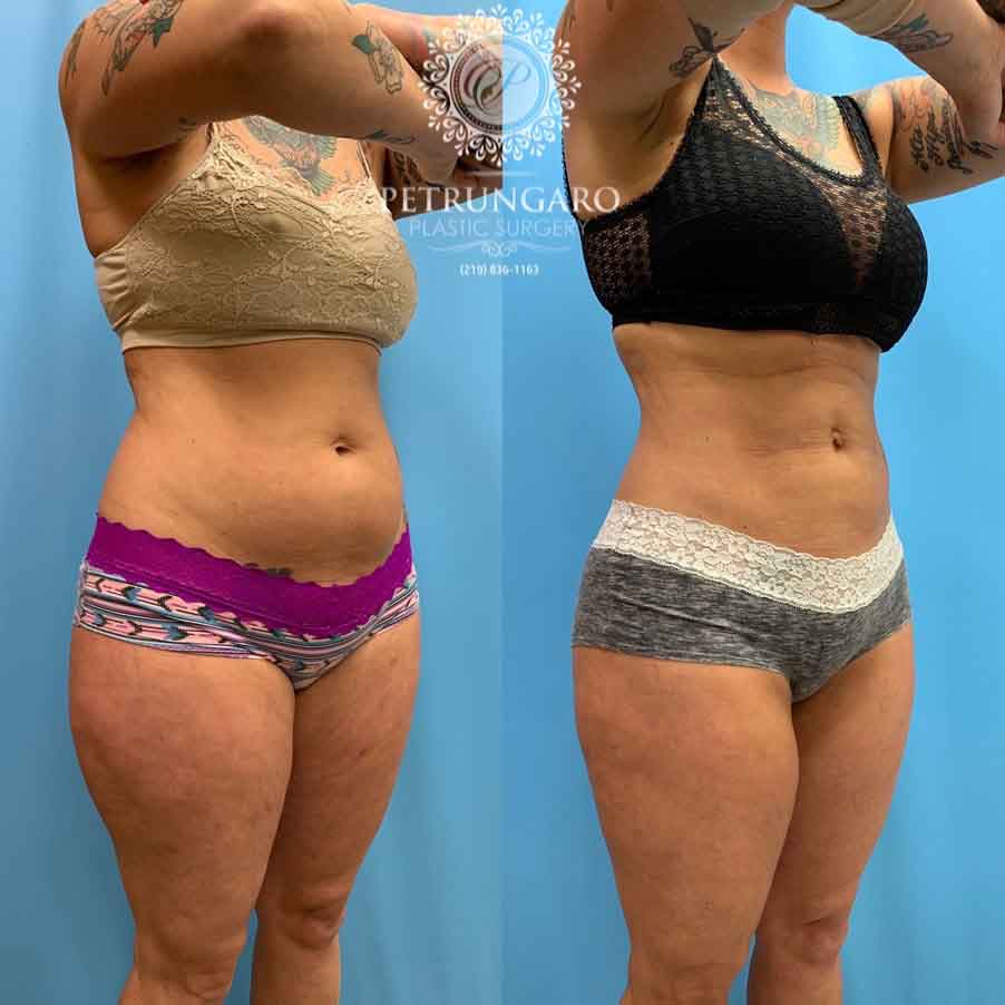 42-before-after-photo-lipo-360-6
