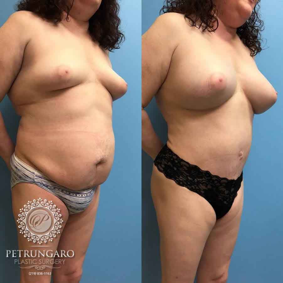 42-breast-augmentation-18-1
