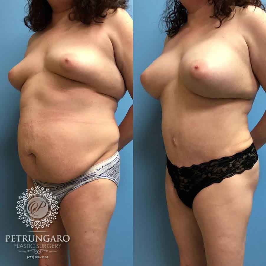 42-breast-augmentation-18-2
