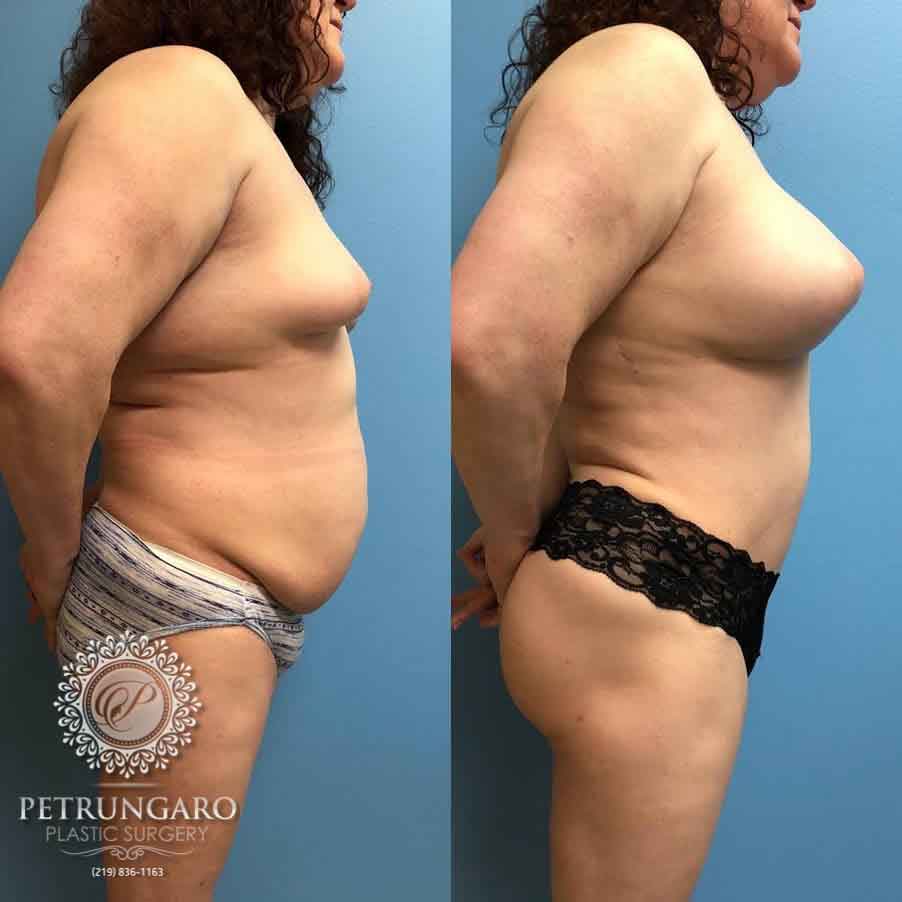 42-breast-augmentation-18-3