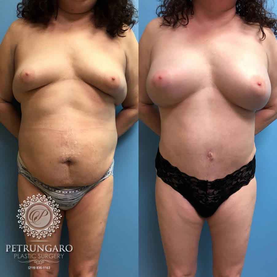 42-breast-augmentation-18-5