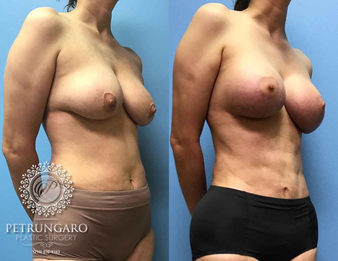 42-breast-lift-augmentation-2