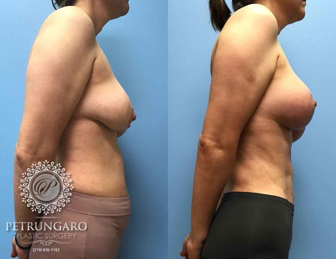 42-breast-lift-augmentation-4