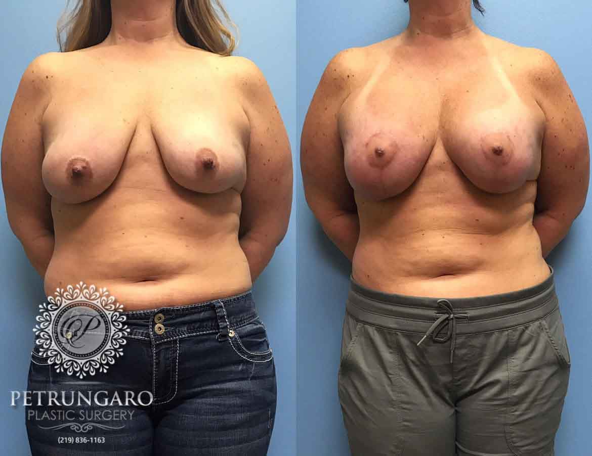 42-breast-lift-augmentation-implants-1