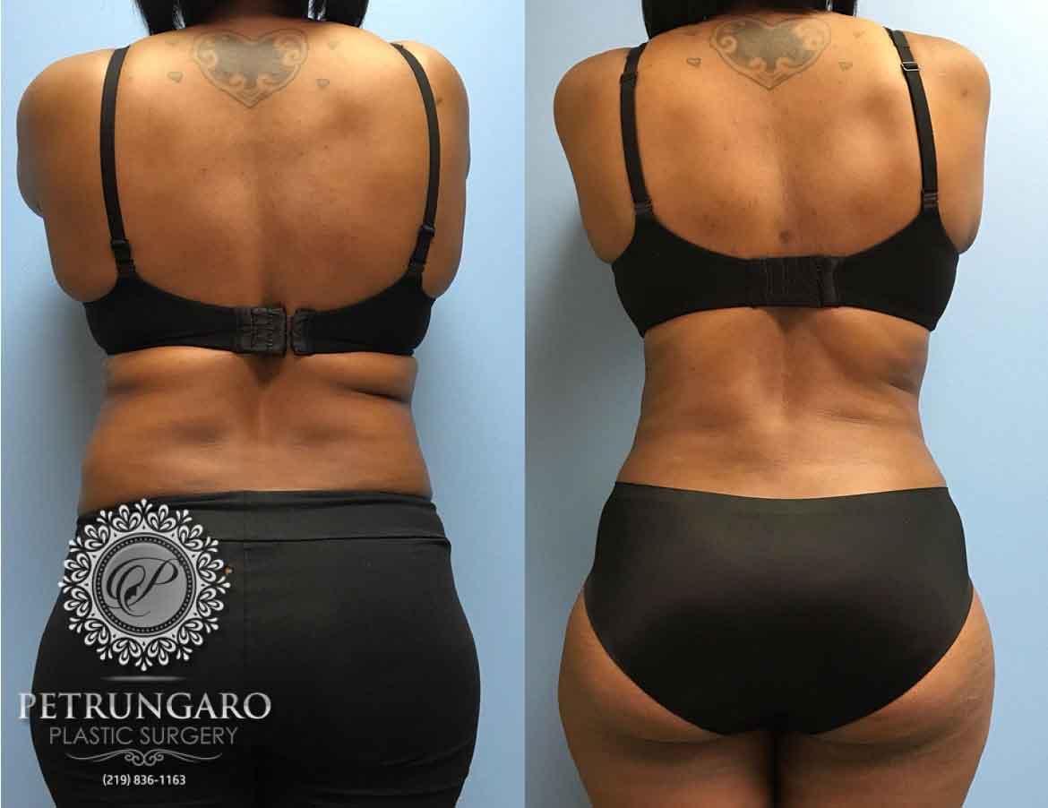 43-year-old-woman-3-months-after-liposuction-1