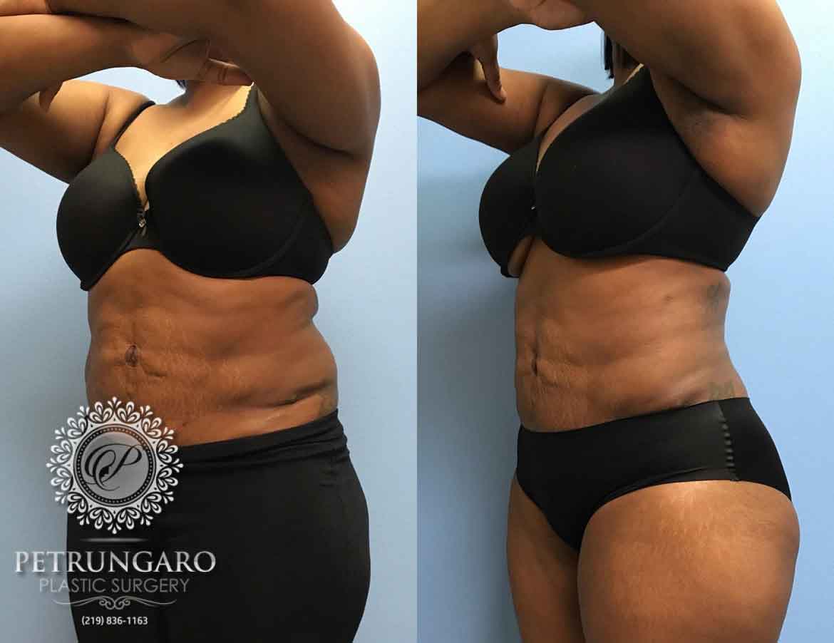 43-year-old-woman-3-months-after-liposuction-2