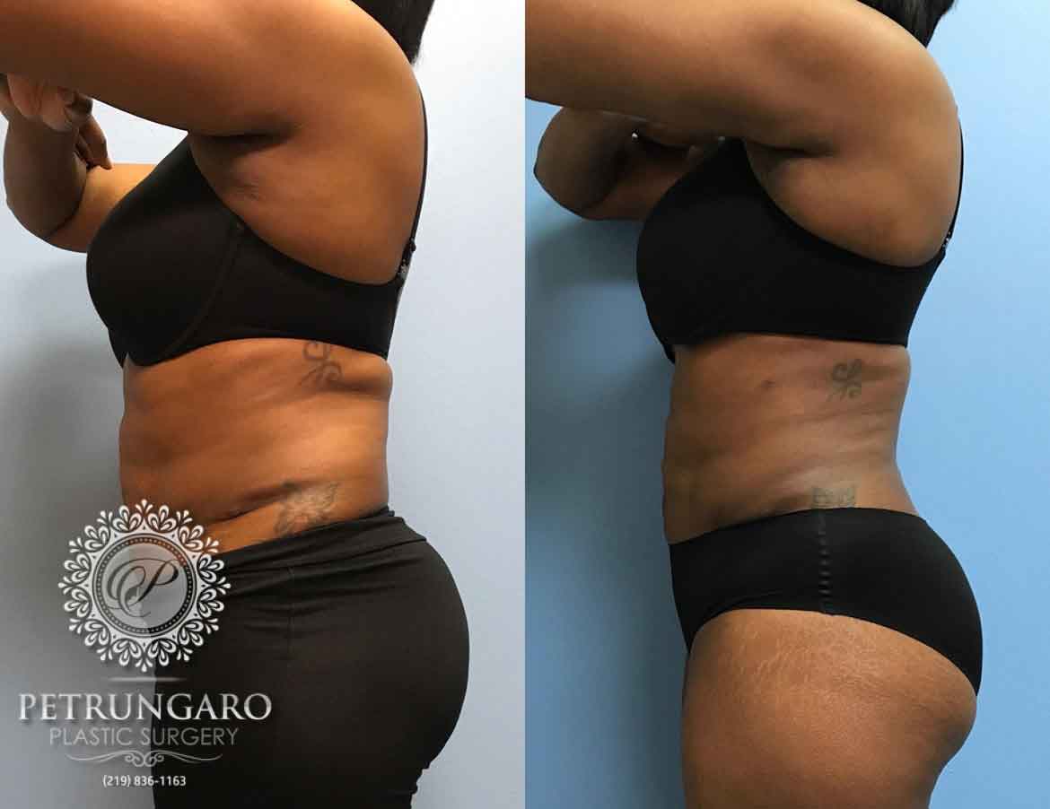 43-year-old-woman-3-months-after-liposuction-4