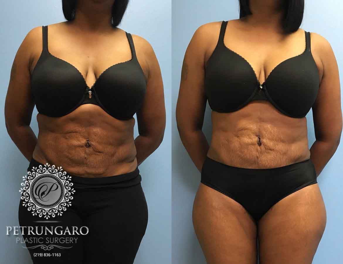 43-year-old-woman-3-months-after-liposuction-6
