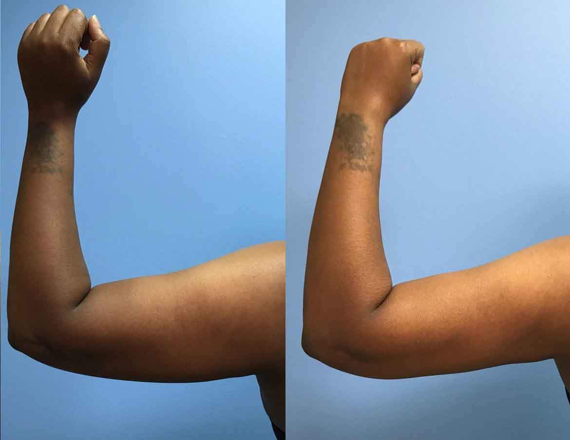 43-year-old-woman-3-months-after-liposuction-posterior-upper-arms-2